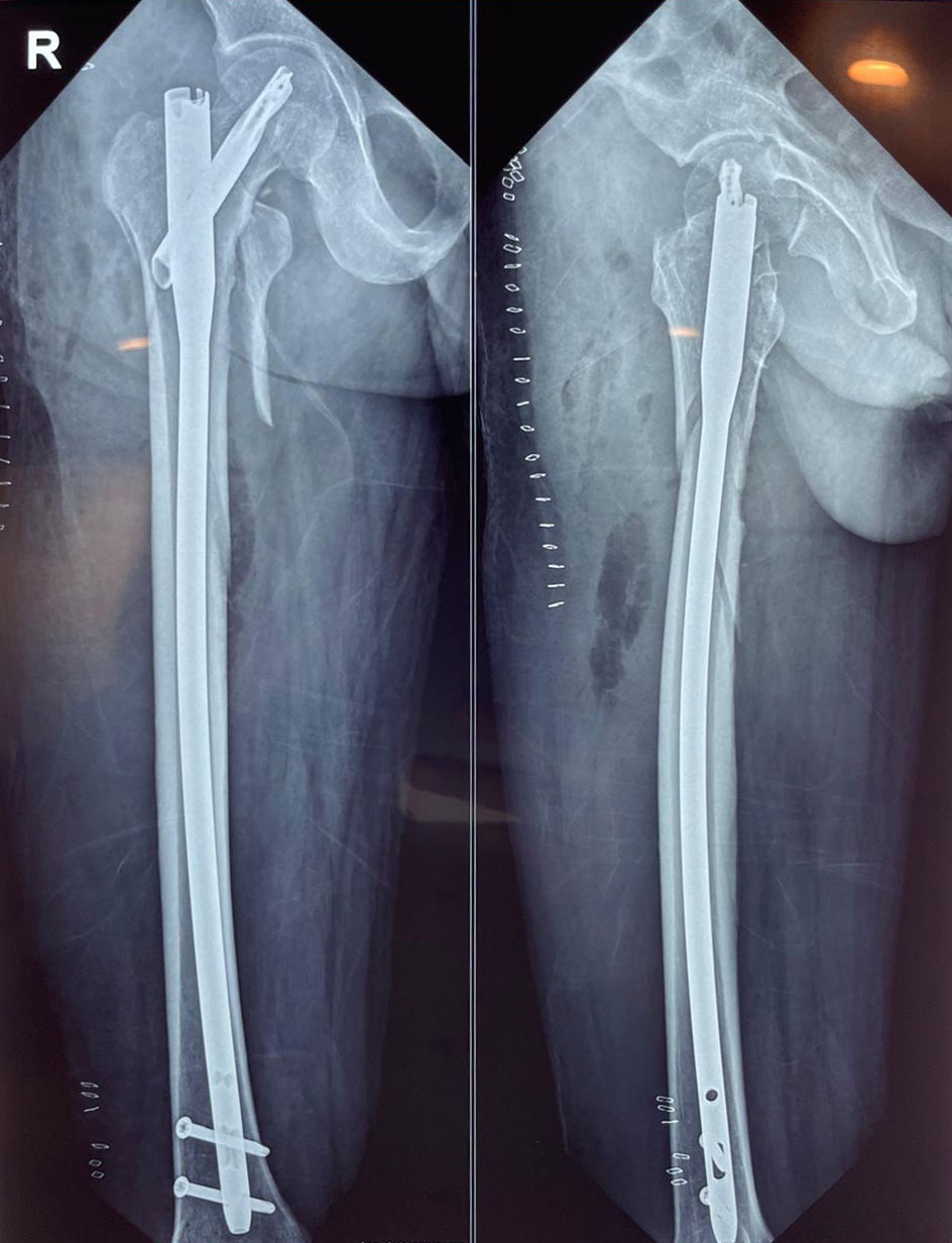 Trauma Case 1 Post-Op