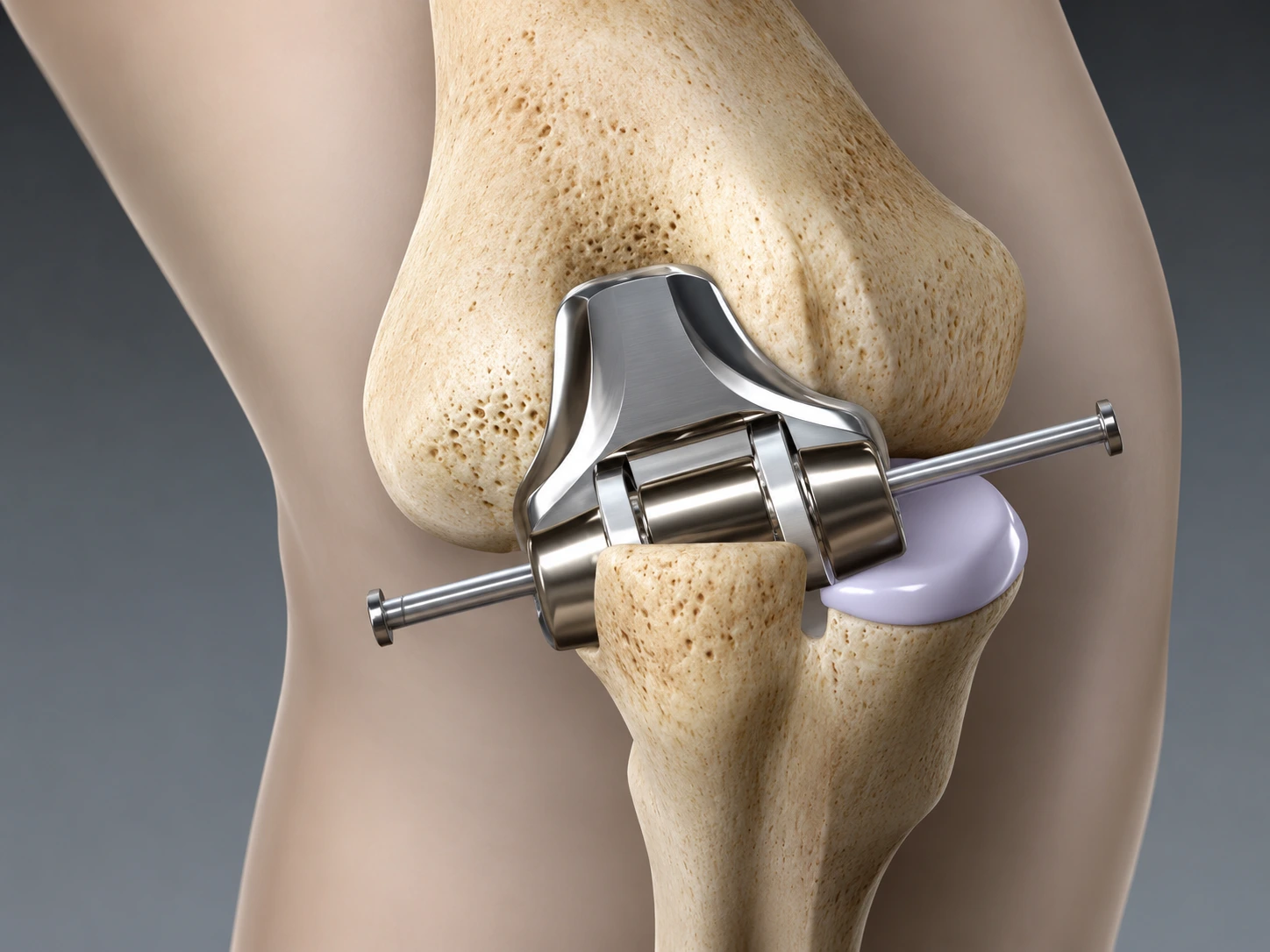 Elbow Replacement