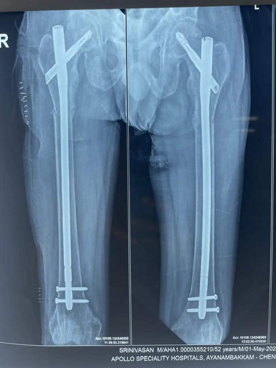 Trauma Case 2 Pre-Op