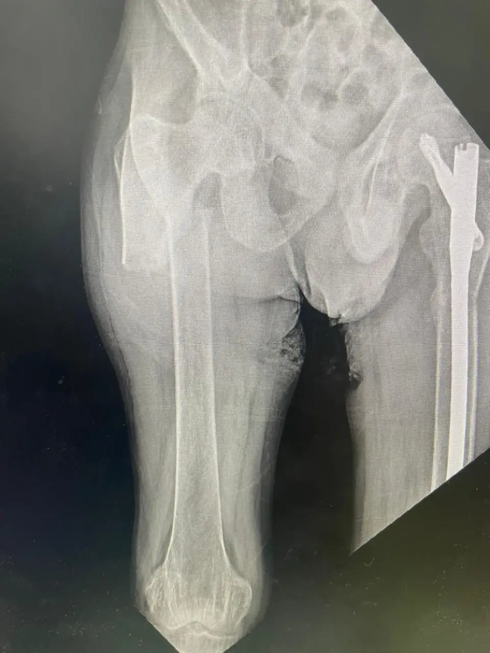 Trauma Case 2 Post-Op