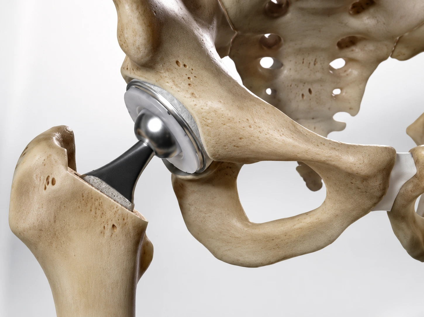 Joint Replacement
