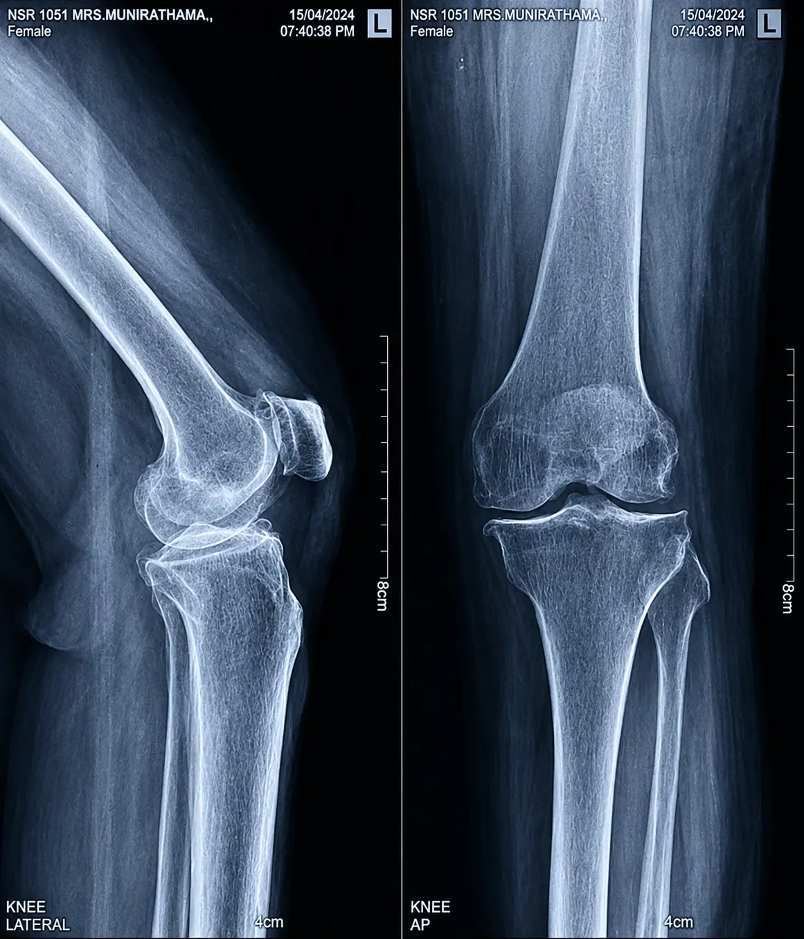 Knee X-Ray Pre-Op