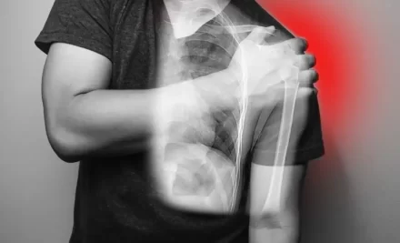 Shoulder Dislocation