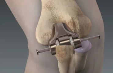 Elbow Replacement