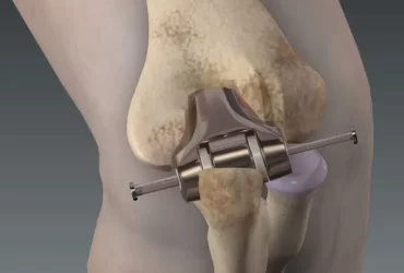 Elbow Replacement