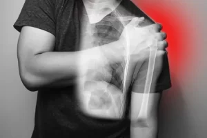 Recurrent Shoulder Dislocation: Causes, Symptoms, and Treatment