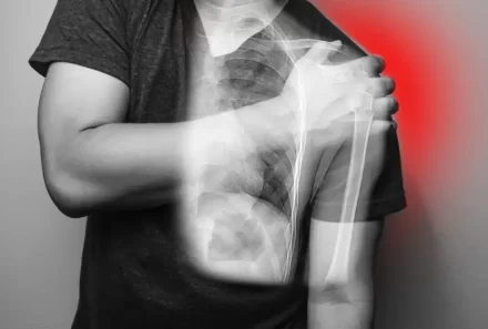 Recurrent Shoulder Dislocation: Causes, Symptoms, and Treatment