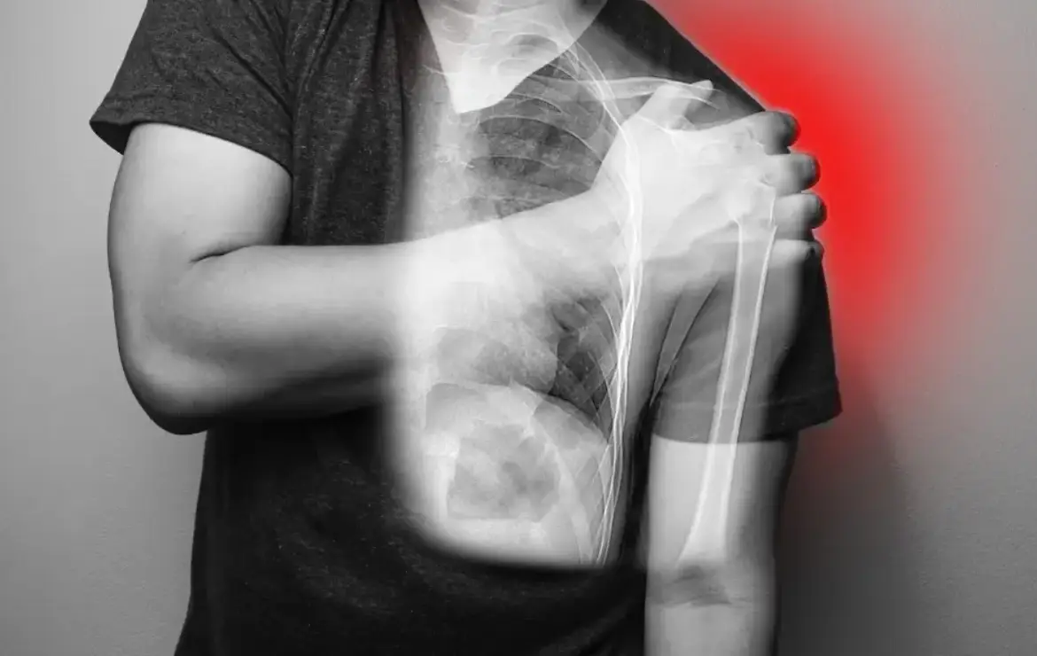 Recurrent Shoulder Dislocation: Causes, Symptoms, and Treatment