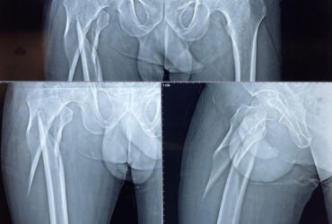 Best Orthopaedic Doctor in Chennai, Best Ortho Doctor in Anna Nagar, Best Ortho Doc Near Me, Best joint replacement surgeon in Chennai, Best knee surgeon in Chennai, Best knee surgeon in Annanagar, Best fracture surgeon in Chennai, Key hole surgeon in Chennai, Key hole surgeon in Anna Nagar, Physiotherapy clinic near me, Best hip replacement surgeon in Anna Nagar, Best hip replacement surgeon in Chennai, Best ortho clinic near me, Best ortho clinic in Chennai, Fracture doctor near me, Best orthopaedic surgeon in Chennai, Best orthopaedic surgeon in Annanagar, Bone doctor near me.