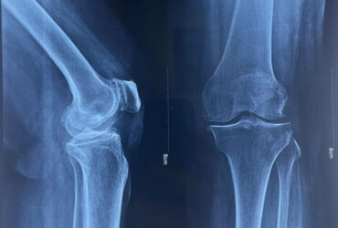 Best Orthopaedic Doctor in Chennai, Best Ortho Doctor in Anna Nagar, Best Ortho Doc Near Me, Best joint replacement surgeon in Chennai, Best knee surgeon in Chennai, Best knee surgeon in Annanagar, Best fracture surgeon in Chennai, Key hole surgeon in Chennai, Key hole surgeon in Anna Nagar, Physiotherapy clinic near me, Best hip replacement surgeon in Anna Nagar, Best hip replacement surgeon in Chennai, Best ortho clinic near me, Best ortho clinic in Chennai, Fracture doctor near me, Best orthopaedic surgeon in Chennai, Best orthopaedic surgeon in Annanagar, Bone doctor near me.