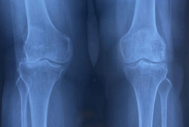 Best fracture surgeon in Chennai