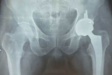 Best hip replacement surgeon in Anna Nagar